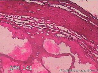 肠系膜赘生物图110