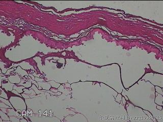 肠系膜赘生物图7
