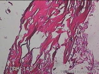 肠系膜赘生物图17
