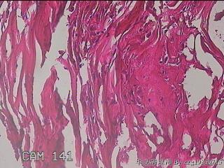 肠系膜赘生物图23