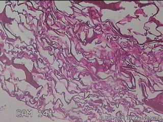 肠系膜赘生物图41