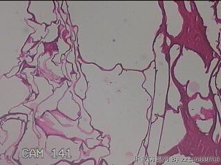 肠系膜赘生物图31