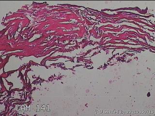 肠系膜赘生物图15