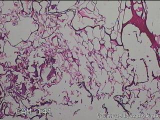 肠系膜赘生物图4