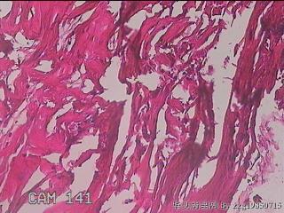 肠系膜赘生物图25