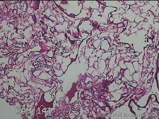 肠系膜赘生物图14