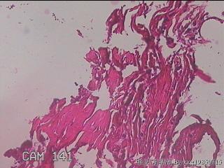 肠系膜赘生物图26
