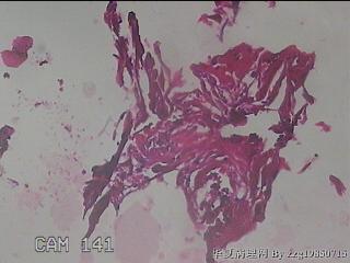 肠系膜赘生物图20