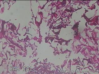 肠系膜赘生物图42