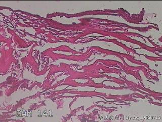 肠系膜赘生物图29