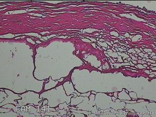 肠系膜赘生物图8