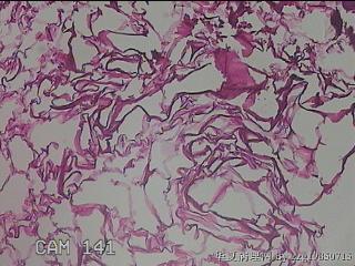 肠系膜赘生物图49