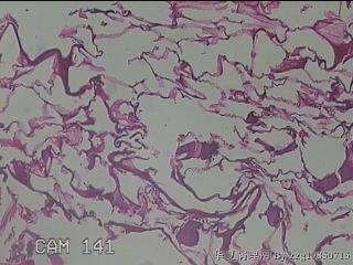 肠系膜赘生物图48
