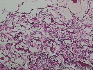 肠系膜赘生物图5