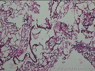 肠系膜赘生物图10