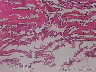 肠系膜赘生物图28