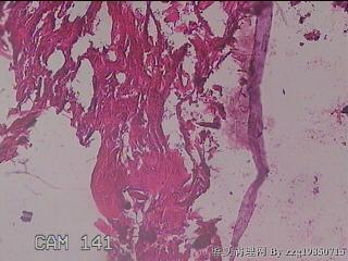 肠系膜赘生物图22