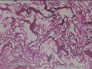 肠系膜赘生物图34