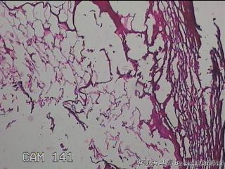 肠系膜赘生物图2
