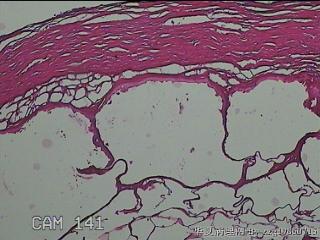 肠系膜赘生物图13