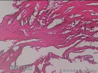肠系膜赘生物图27