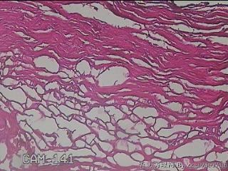 肠系膜赘生物图46