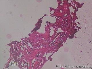 肠系膜赘生物图21
