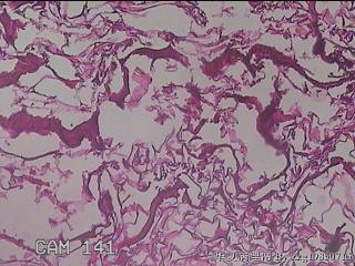 肠系膜赘生物图35
