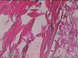 肠系膜赘生物图24