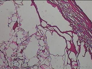 肠系膜赘生物图3