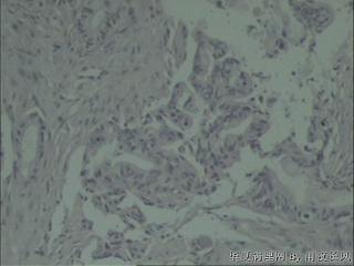 胆总管吻合口瘢痕组织，胆管细胞癌？图14