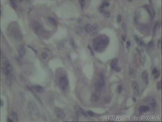 胆总管吻合口瘢痕组织，胆管细胞癌？图8