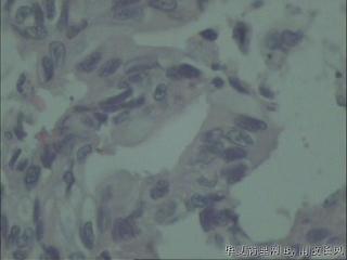 胆总管吻合口瘢痕组织，胆管细胞癌？图16