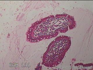 回肠末端粘膜图4