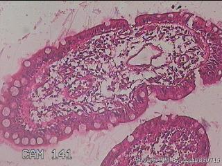 回肠末端粘膜图6