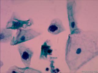 TCT   ACS-H?  LSIL?   HSIL?图5