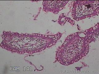 回肠末端粘膜图23