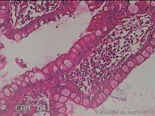 回肠末端粘膜图17