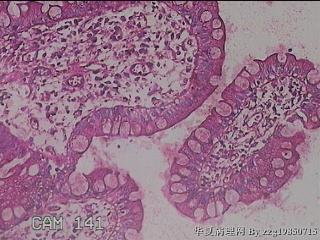 回肠末端粘膜图26