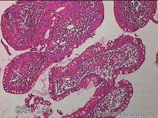 回肠末端粘膜图2