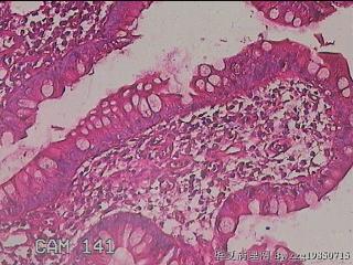 回肠末端粘膜图11