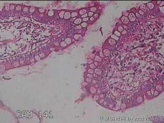 回肠末端粘膜图31
