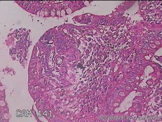 回肠末端粘膜图33