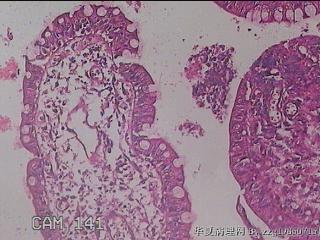 回肠末端粘膜图35