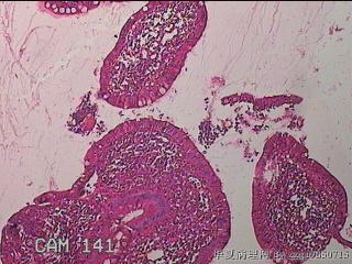 回肠末端粘膜图3