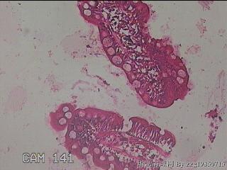 回肠末端粘膜图18