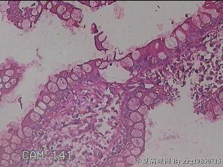 回肠末端粘膜图30