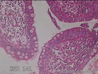 回肠末端粘膜图36