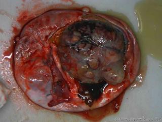 右卵巢巨大肿瘤图2
