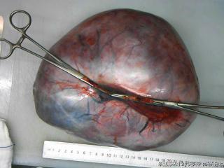 右卵巢巨大肿瘤图1